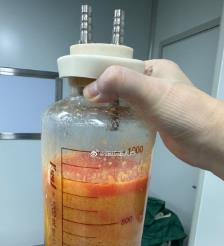靖边水动力吸脂手术要做多久？